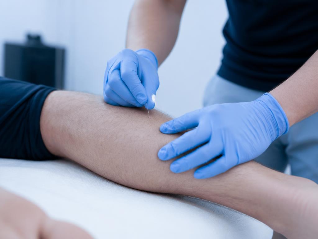 Dry Needling at Rec Center Physical Therapy